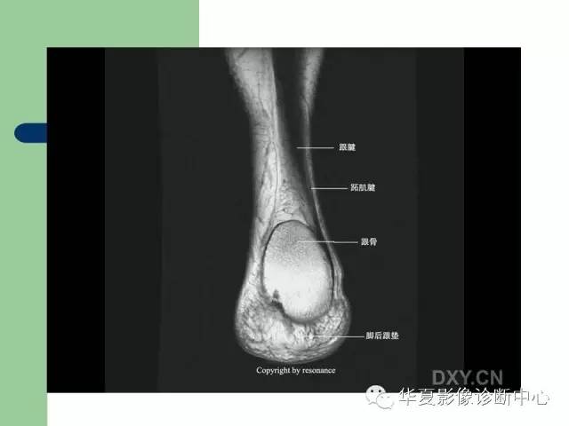 影像PPT - 【PPT】大关节MRI解剖-86