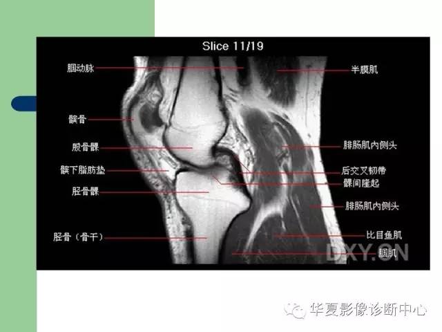 影像PPT - 【PPT】大关节MRI解剖-14