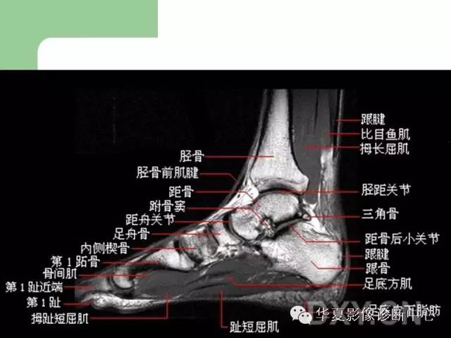 影像PPT - 【PPT】大关节MRI解剖-79