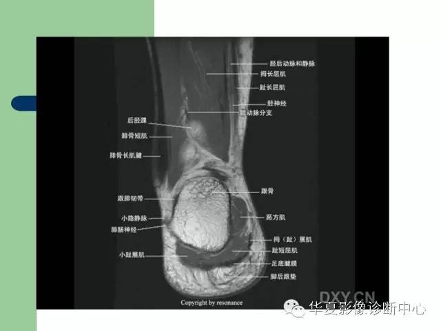 影像PPT - 【PPT】大关节MRI解剖-91