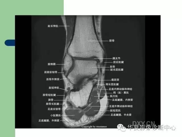 影像PPT - 【PPT】大关节MRI解剖-95