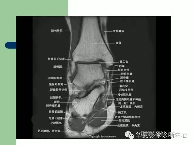 影像PPT - 【PPT】大关节MRI解剖-96