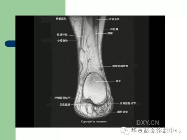 影像PPT - 【PPT】大关节MRI解剖-87