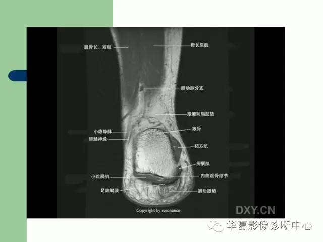 影像PPT - 【PPT】大关节MRI解剖-89