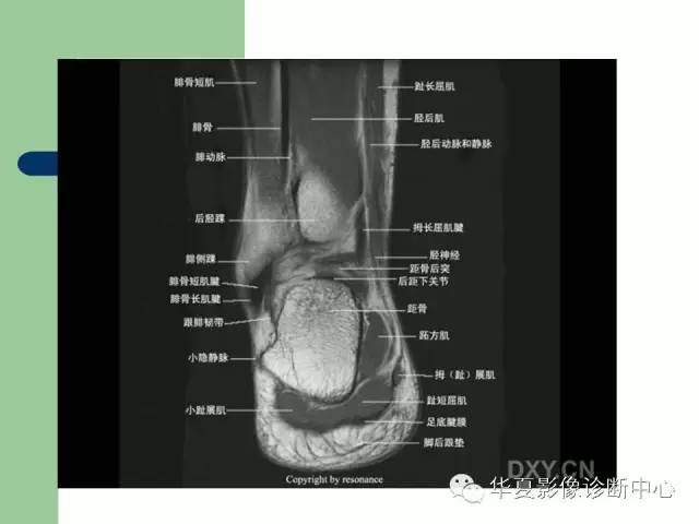 影像PPT - 【PPT】大关节MRI解剖-92