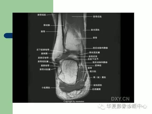 影像PPT - 【PPT】大关节MRI解剖-93