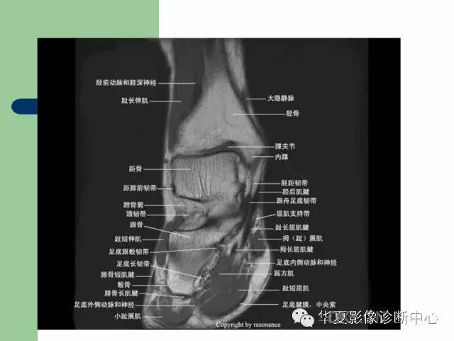影像PPT - 【PPT】大关节MRI解剖-97
