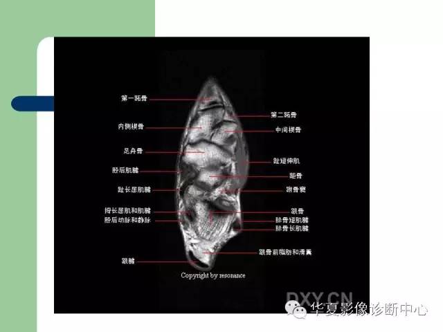 影像PPT - 【PPT】大关节MRI解剖-64