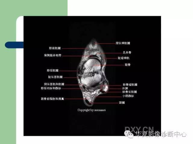 影像PPT - 【PPT】大关节MRI解剖-61