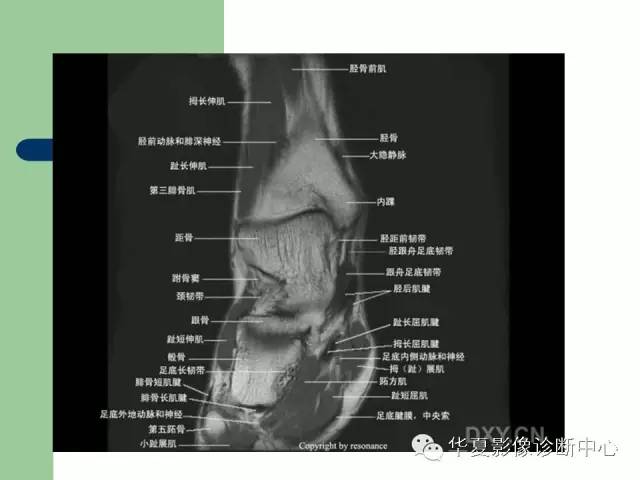 影像PPT - 【PPT】大关节MRI解剖-98