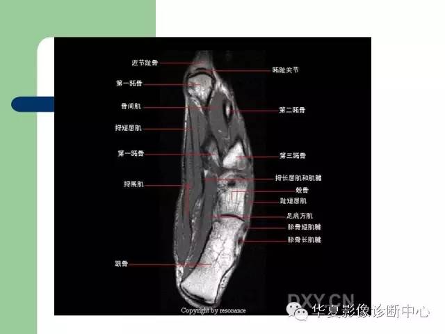 影像PPT - 【PPT】大关节MRI解剖-69