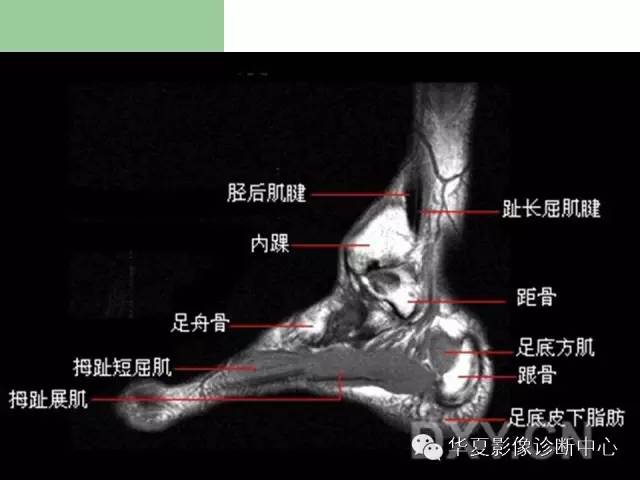 影像PPT - 【PPT】大关节MRI解剖-84