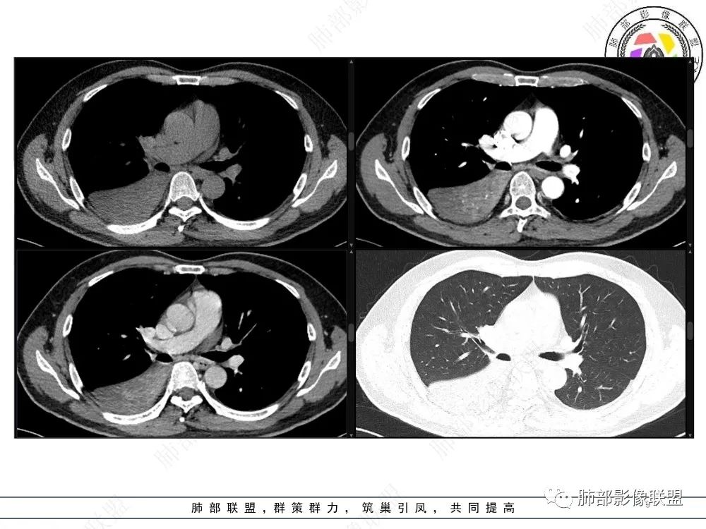 影像PPT - 【病例】以“大片实变影”为表现的粘液表皮样癌-9 影像PPT - 【病例】以“大片实变影”为表现的粘液表皮样癌-9