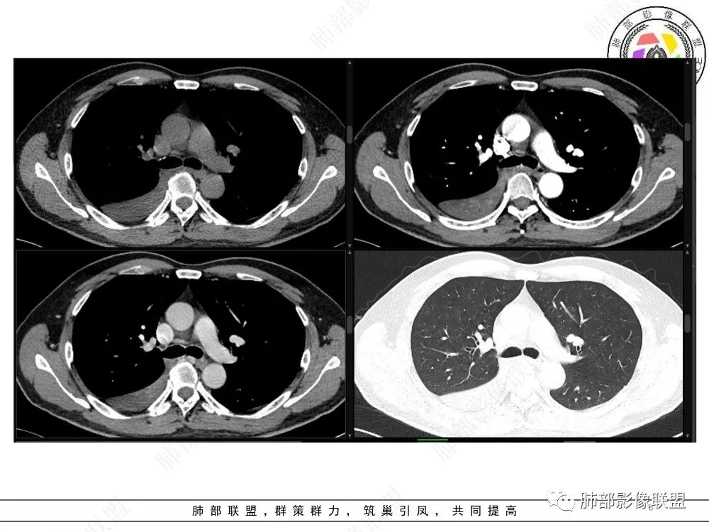 影像PPT - 【病例】以“大片实变影”为表现的粘液表皮样癌-8 影像PPT - 【病例】以“大片实变影”为表现的粘液表皮样癌-8