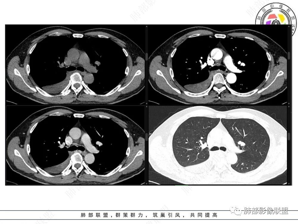 影像PPT - 【病例】以“大片实变影”为表现的粘液表皮样癌-7 影像PPT - 【病例】以“大片实变影”为表现的粘液表皮样癌-7