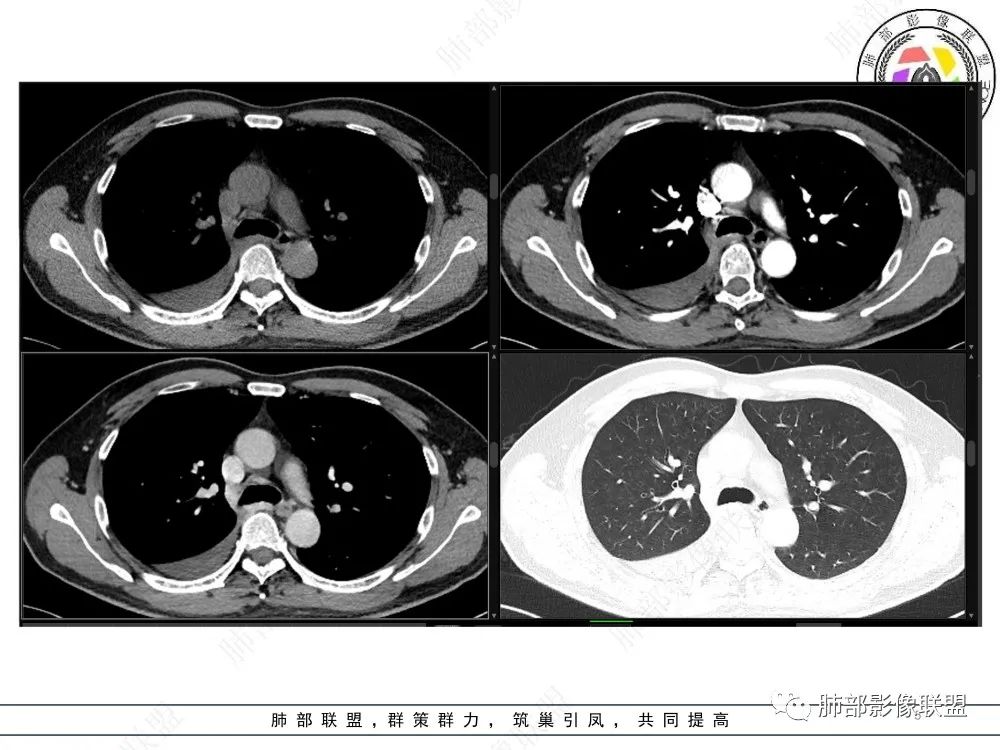 影像PPT - 【病例】以“大片实变影”为表现的粘液表皮样癌-5 影像PPT - 【病例】以“大片实变影”为表现的粘液表皮样癌-5