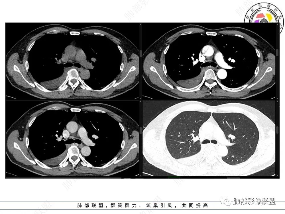 影像PPT - 【病例】以“大片实变影”为表现的粘液表皮样癌-6 影像PPT - 【病例】以“大片实变影”为表现的粘液表皮样癌-6