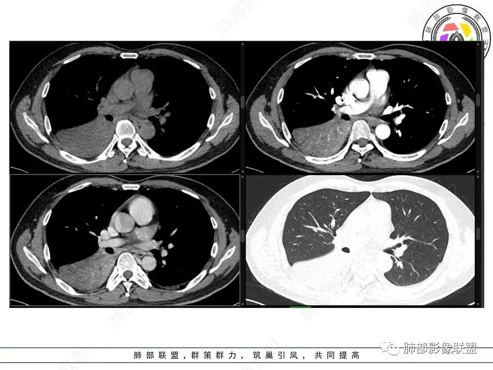 影像PPT - 【病例】以“大片实变影”为表现的粘液表皮样癌-11 影像PPT - 【病例】以“大片实变影”为表现的粘液表皮样癌-11