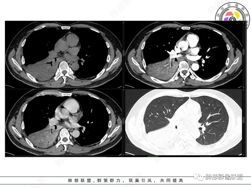 影像PPT - 【病例】以“大片实变影”为表现的粘液表皮样癌-14 影像PPT - 【病例】以“大片实变影”为表现的粘液表皮样癌-14