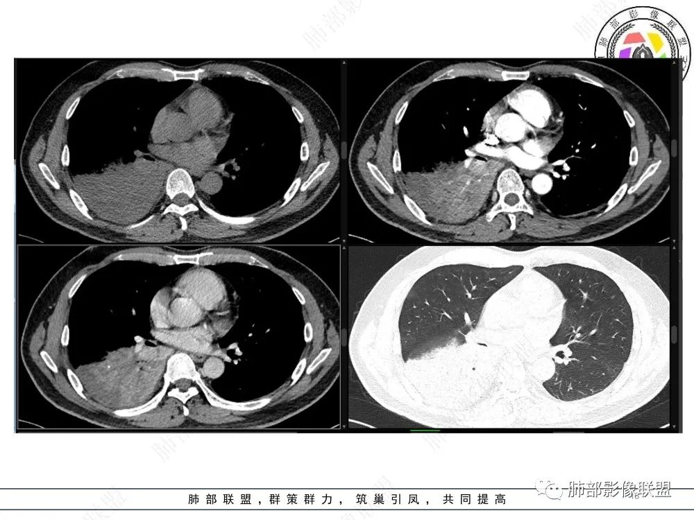 影像PPT - 【病例】以“大片实变影”为表现的粘液表皮样癌-18 影像PPT - 【病例】以“大片实变影”为表现的粘液表皮样癌-18