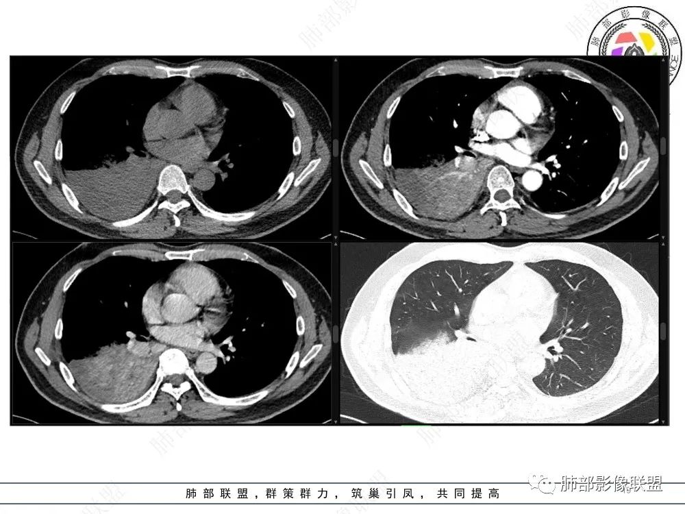 影像PPT - 【病例】以“大片实变影”为表现的粘液表皮样癌-19 影像PPT - 【病例】以“大片实变影”为表现的粘液表皮样癌-19