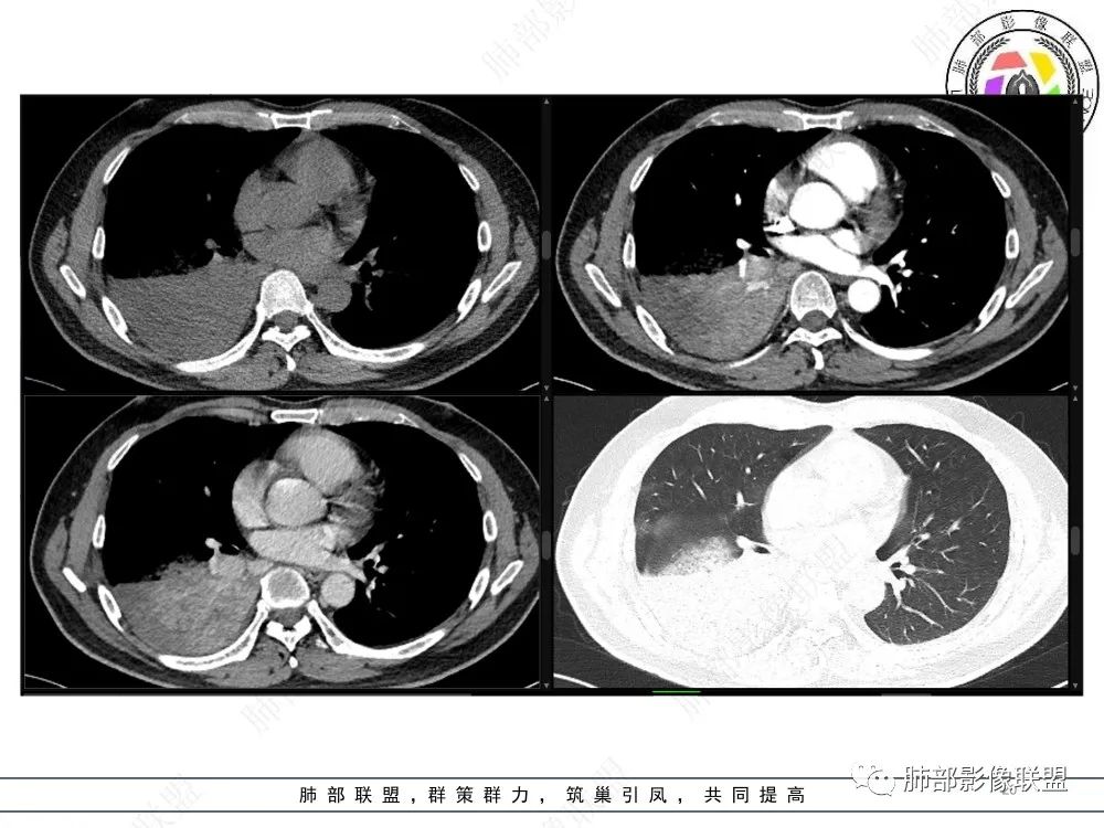 影像PPT - 【病例】以“大片实变影”为表现的粘液表皮样癌-20 影像PPT - 【病例】以“大片实变影”为表现的粘液表皮样癌-20