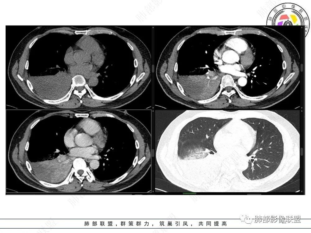 影像PPT - 【病例】以“大片实变影”为表现的粘液表皮样癌-22 影像PPT - 【病例】以“大片实变影”为表现的粘液表皮样癌-22