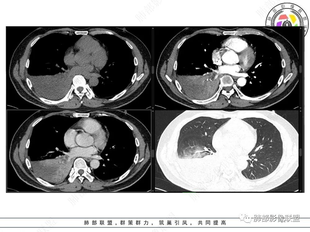 影像PPT - 【病例】以“大片实变影”为表现的粘液表皮样癌-24 影像PPT - 【病例】以“大片实变影”为表现的粘液表皮样癌-24