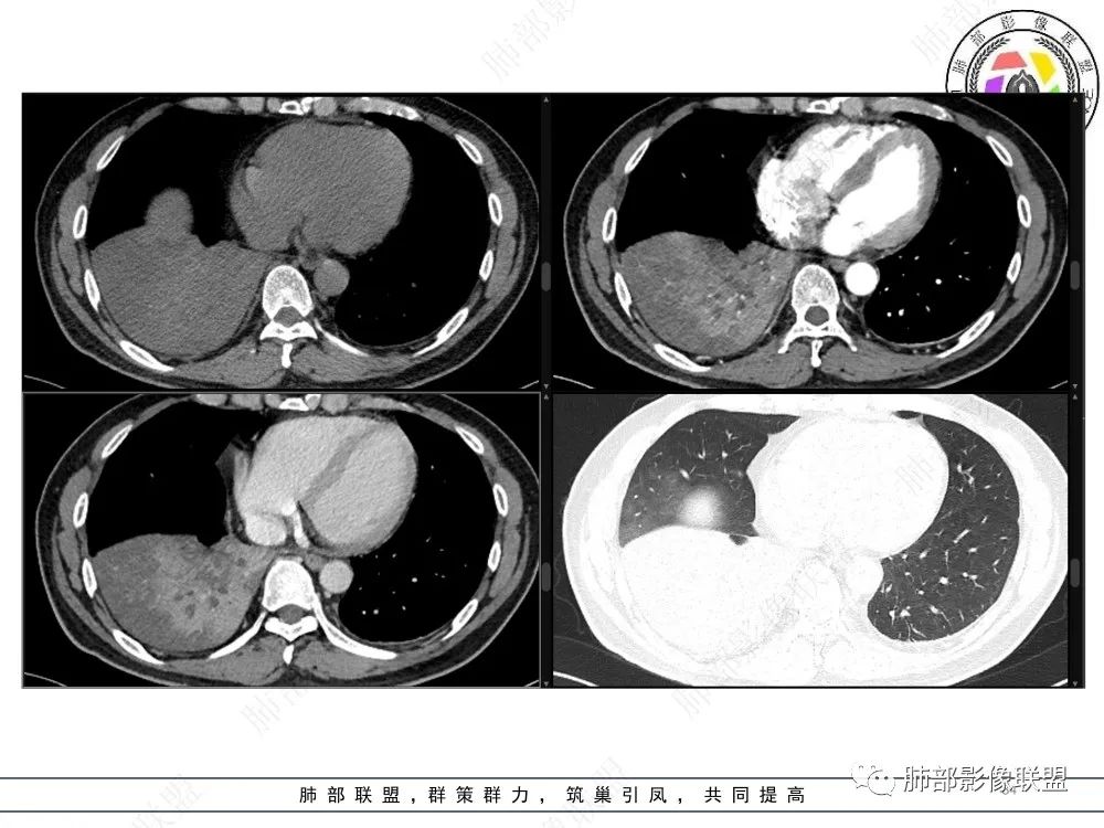 影像PPT - 【病例】以“大片实变影”为表现的粘液表皮样癌-34 影像PPT - 【病例】以“大片实变影”为表现的粘液表皮样癌-34