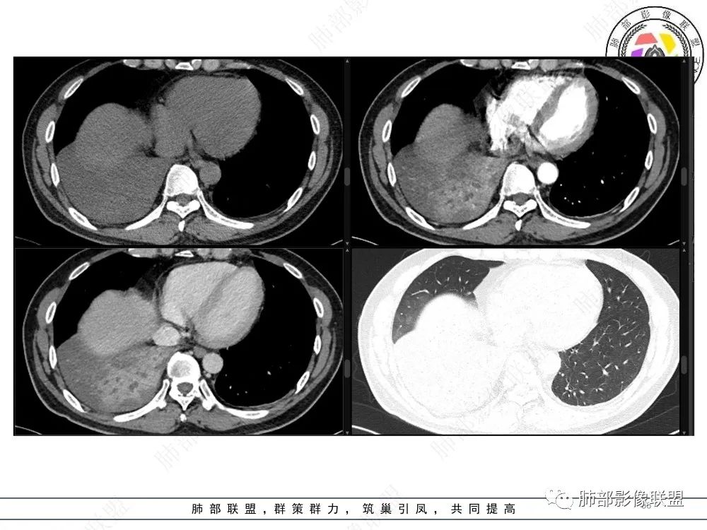 影像PPT - 【病例】以“大片实变影”为表现的粘液表皮样癌-36 影像PPT - 【病例】以“大片实变影”为表现的粘液表皮样癌-36