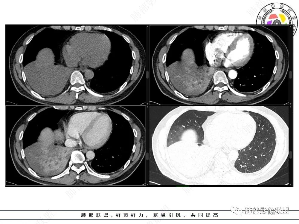 影像PPT - 【病例】以“大片实变影”为表现的粘液表皮样癌-35 影像PPT - 【病例】以“大片实变影”为表现的粘液表皮样癌-35
