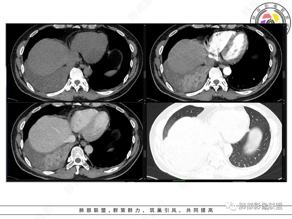 影像PPT - 【病例】以“大片实变影”为表现的粘液表皮样癌-38 影像PPT - 【病例】以“大片实变影”为表现的粘液表皮样癌-38