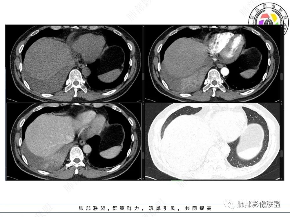 影像PPT - 【病例】以“大片实变影”为表现的粘液表皮样癌-39 影像PPT - 【病例】以“大片实变影”为表现的粘液表皮样癌-39