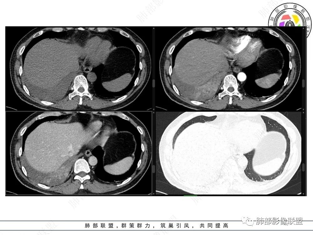影像PPT - 【病例】以“大片实变影”为表现的粘液表皮样癌-40 影像PPT - 【病例】以“大片实变影”为表现的粘液表皮样癌-40