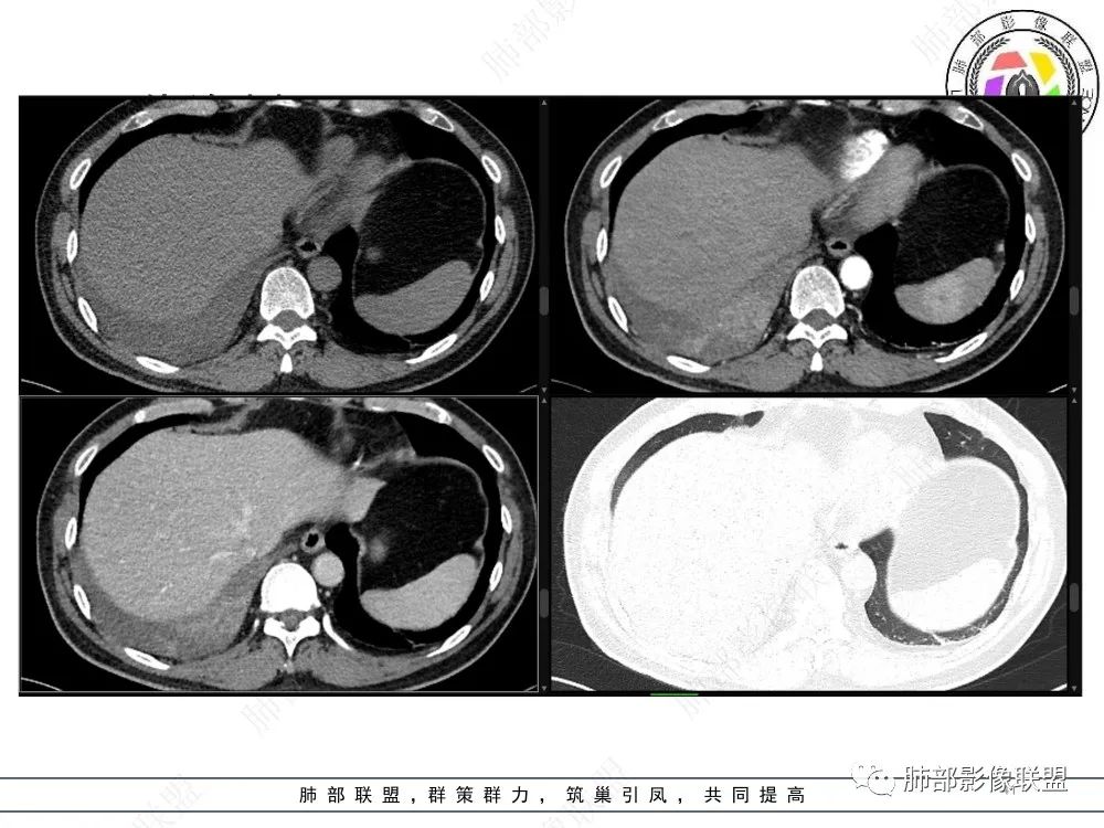 影像PPT - 【病例】以“大片实变影”为表现的粘液表皮样癌-41 影像PPT - 【病例】以“大片实变影”为表现的粘液表皮样癌-41