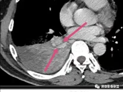 影像PPT - 【病例】以“大片实变影”为表现的粘液表皮样癌-46 影像PPT - 【病例】以“大片实变影”为表现的粘液表皮样癌-46