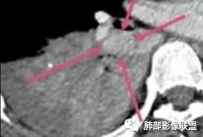 影像PPT - 【病例】以“大片实变影”为表现的粘液表皮样癌-44 影像PPT - 【病例】以“大片实变影”为表现的粘液表皮样癌-44