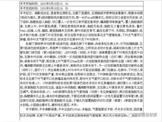 影像PPT - 【病例】以“大片实变影”为表现的粘液表皮样癌-81 影像PPT - 【病例】以“大片实变影”为表现的粘液表皮样癌-81