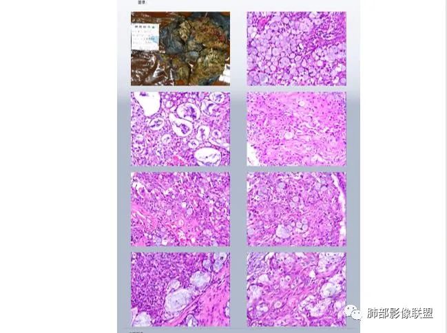影像PPT - 【病例】以“大片实变影”为表现的粘液表皮样癌-82 影像PPT - 【病例】以“大片实变影”为表现的粘液表皮样癌-82
