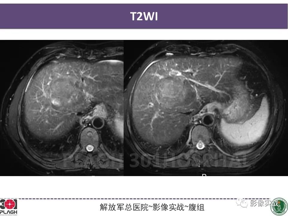 影像PPT - 【病例】原发性肝癌伴出血1例MR影像-5