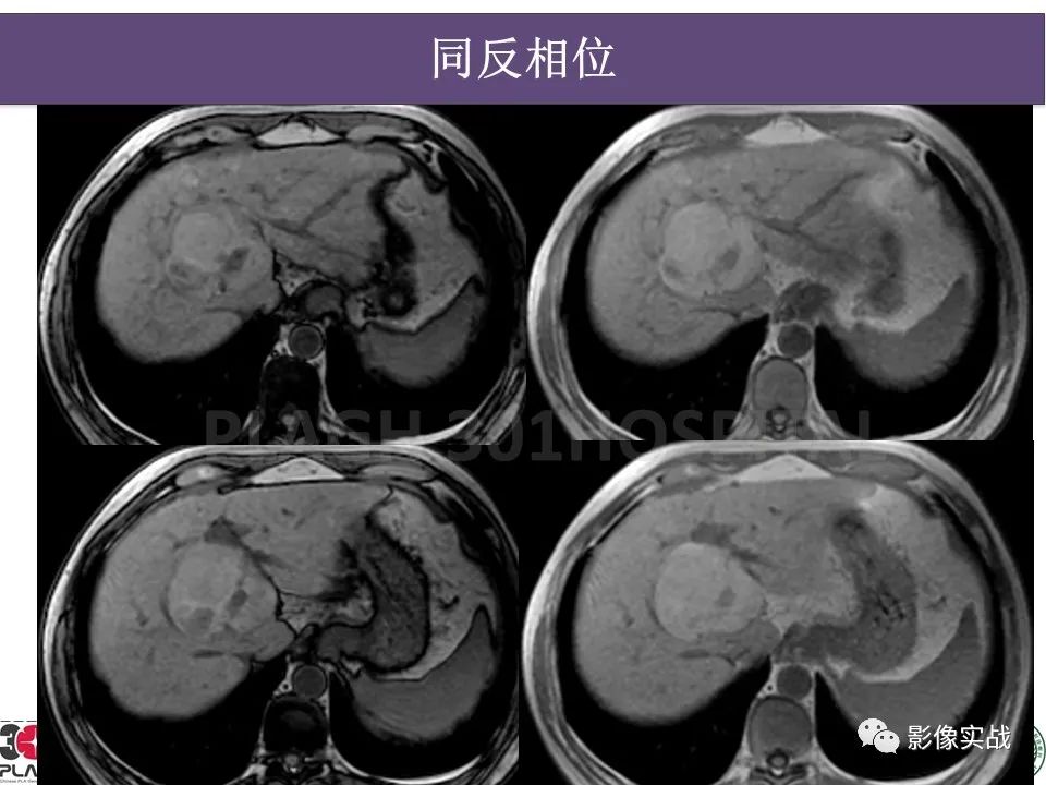 影像PPT - 【病例】原发性肝癌伴出血1例MR影像-7