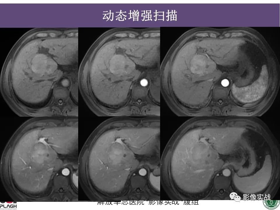影像PPT - 【病例】原发性肝癌伴出血1例MR影像-9
