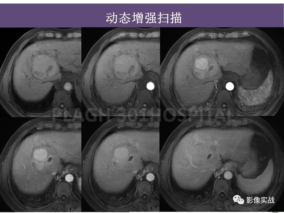 影像PPT - 【病例】原发性肝癌伴出血1例MR影像-8
