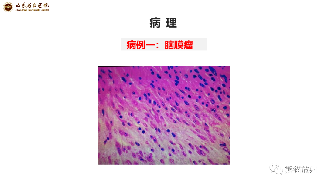 影像PPT - 【病例】侧脑室脑膜瘤 VS 淋巴瘤-14