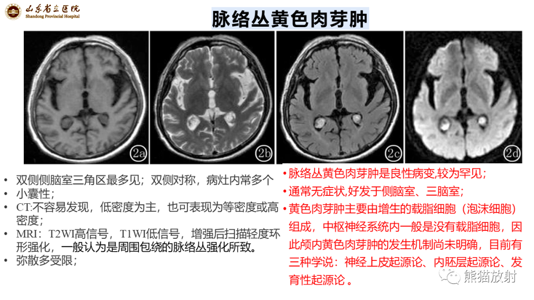 影像PPT - 【病例】侧脑室脑膜瘤 VS 淋巴瘤-21