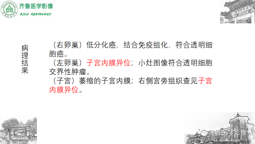 影像PPT - 【病例】卵巢透明细胞癌3例CT及MR影像-6