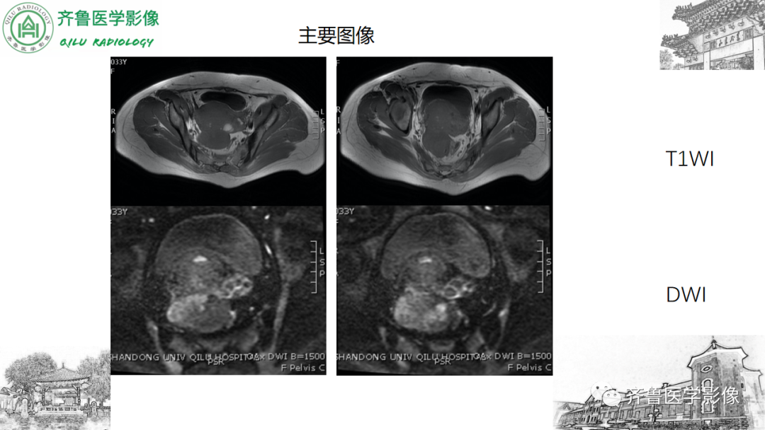 影像PPT - 【病例】卵巢透明细胞癌3例CT及MR影像-8