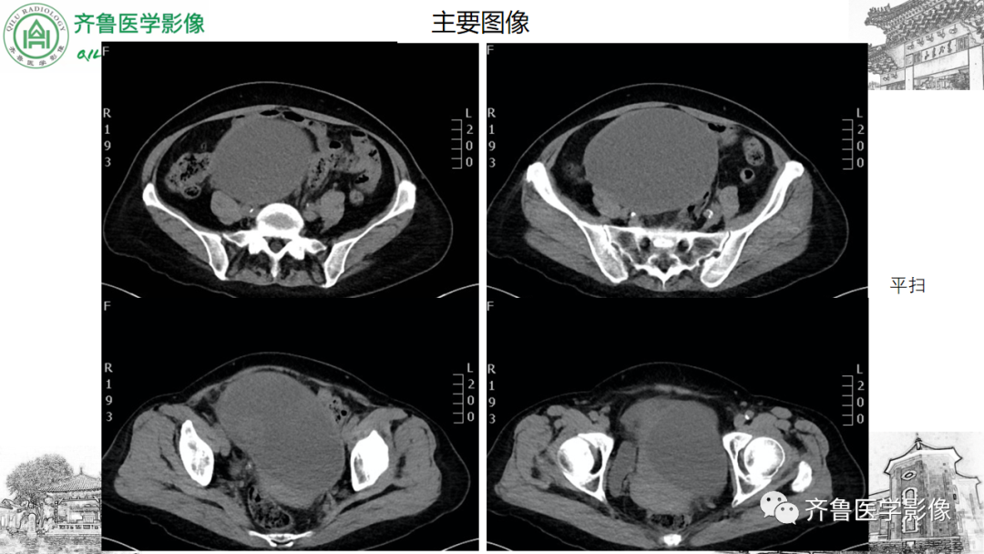 影像PPT - 【病例】卵巢透明细胞癌3例CT及MR影像-3