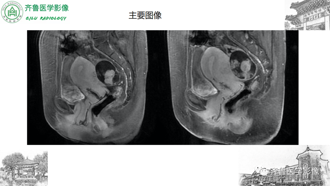 影像PPT - 【病例】卵巢透明细胞癌3例CT及MR影像-11