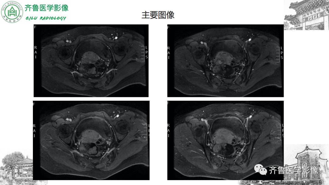 影像PPT - 【病例】卵巢透明细胞癌3例CT及MR影像-10